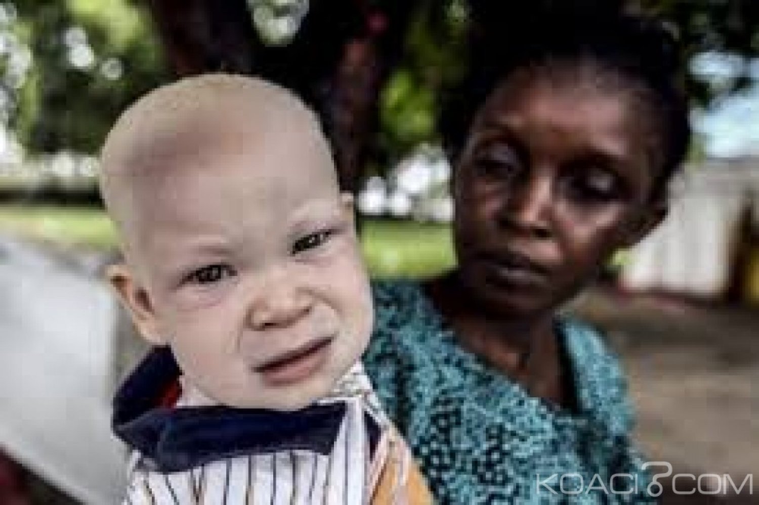 Malawi : Un homme condamné à  la peine de mort pour avoir tué un albinos pour devenir riche