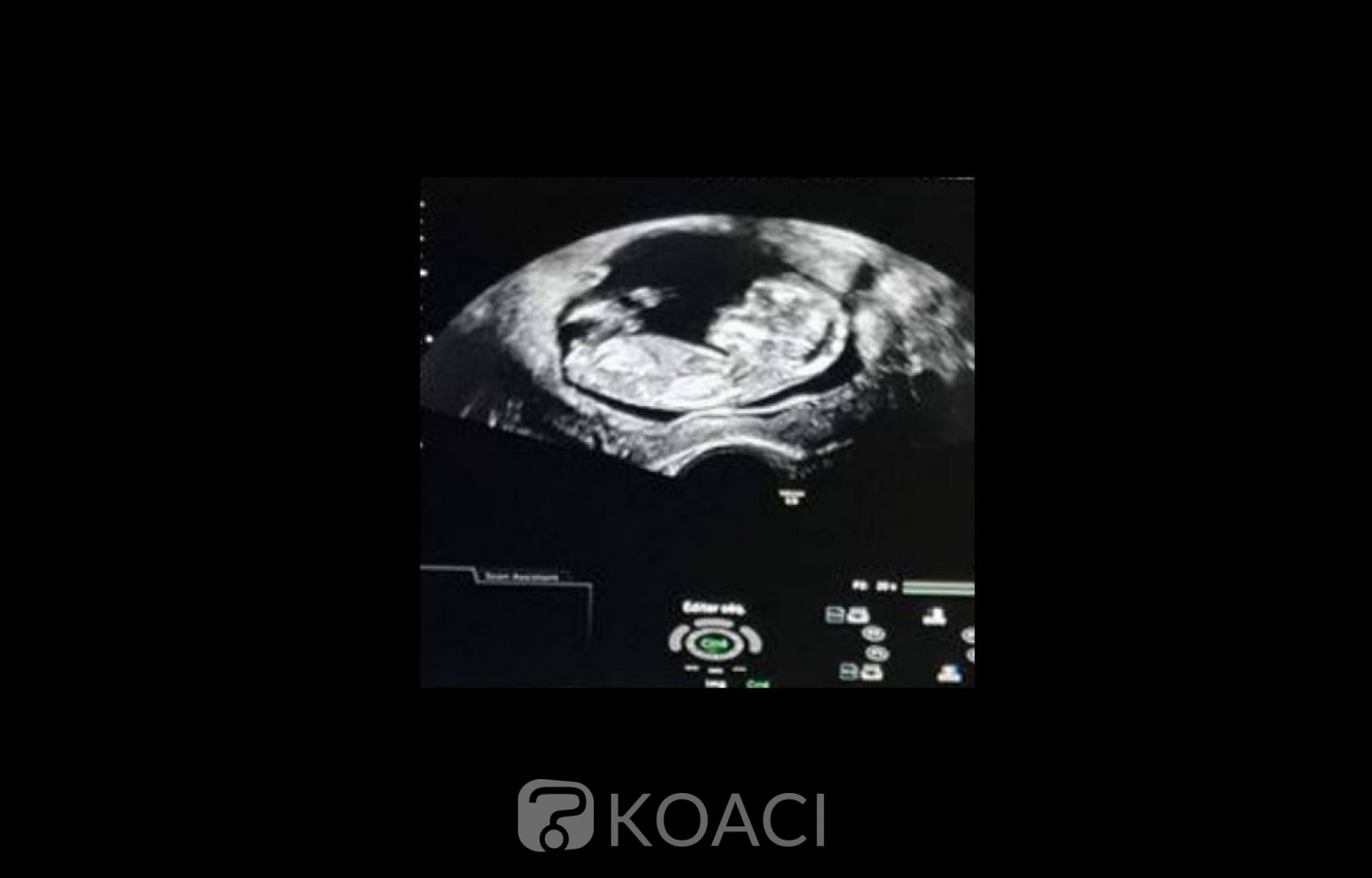 Côte d'Ivoire :   61,7% de filles ont pratiqué un avortement provoqué et 18% de la mortalité maternelle est lié à cette pratique