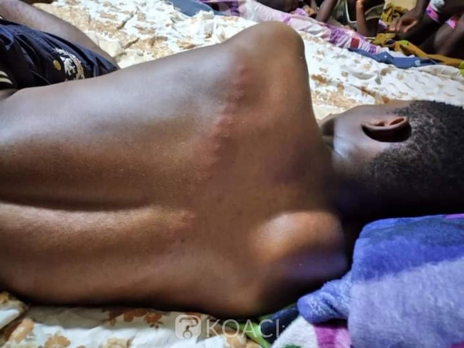 Côte d'Ivoire : Yamoussoukro, un jeune violemment frappé et laissé dans un état comateux par des bandits qui voulaient sa moto