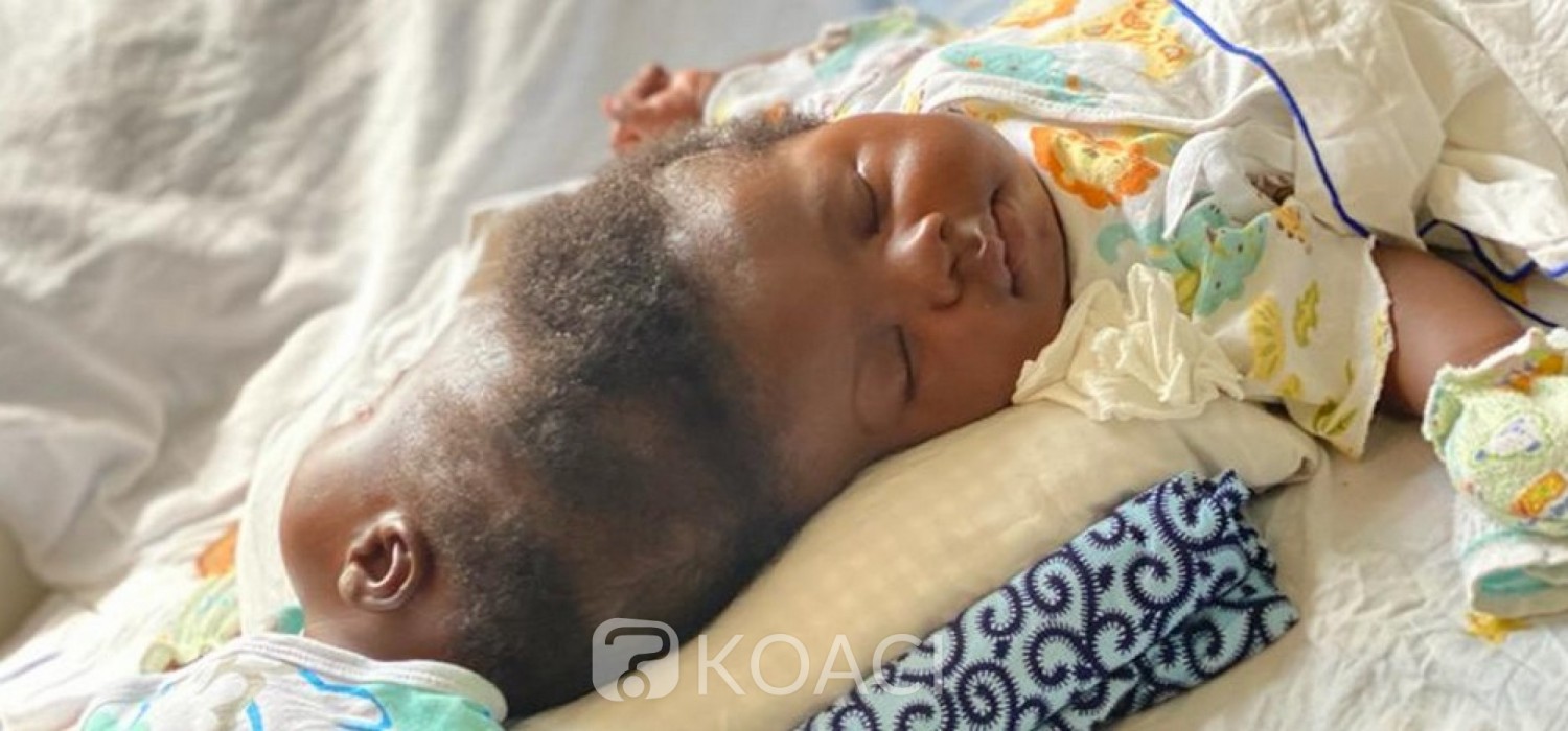 Ghana :  SOS pour des jumeaux siamois à séparer