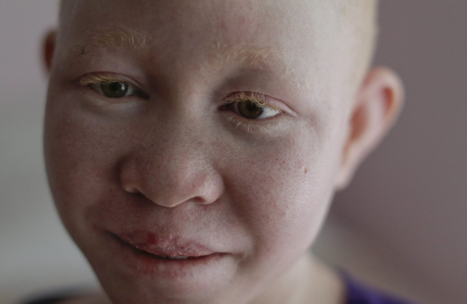 Burundi : Un petit albinos de 4 ans tué et désossé pour des rites de sorcellerie