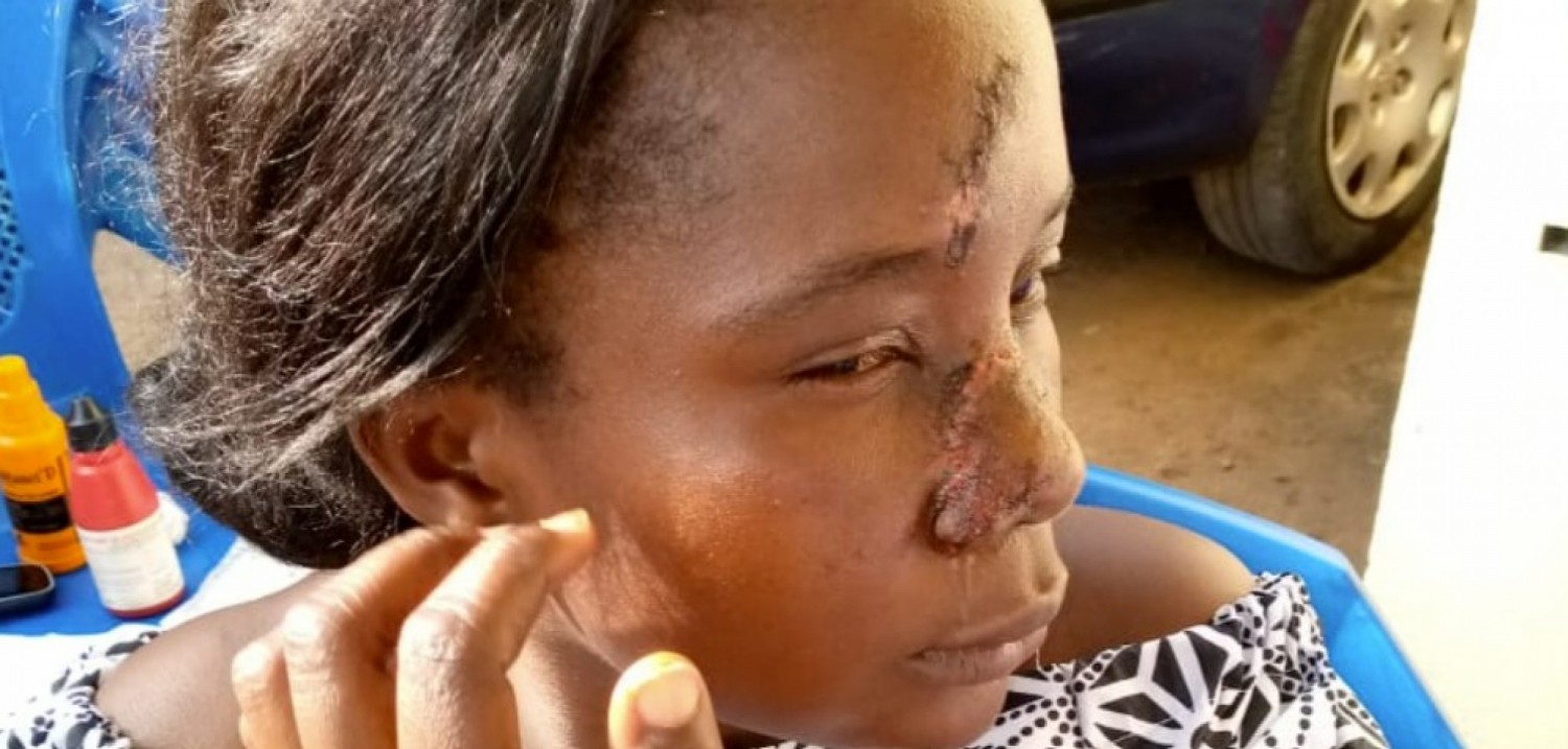 Côte d'Ivoire : Béoumi, la femme d'un enseignant tailladée à la machette, face aux cas répétés d'agression dans le village de Kaabo, tous les instituteurs réclament leur affectation