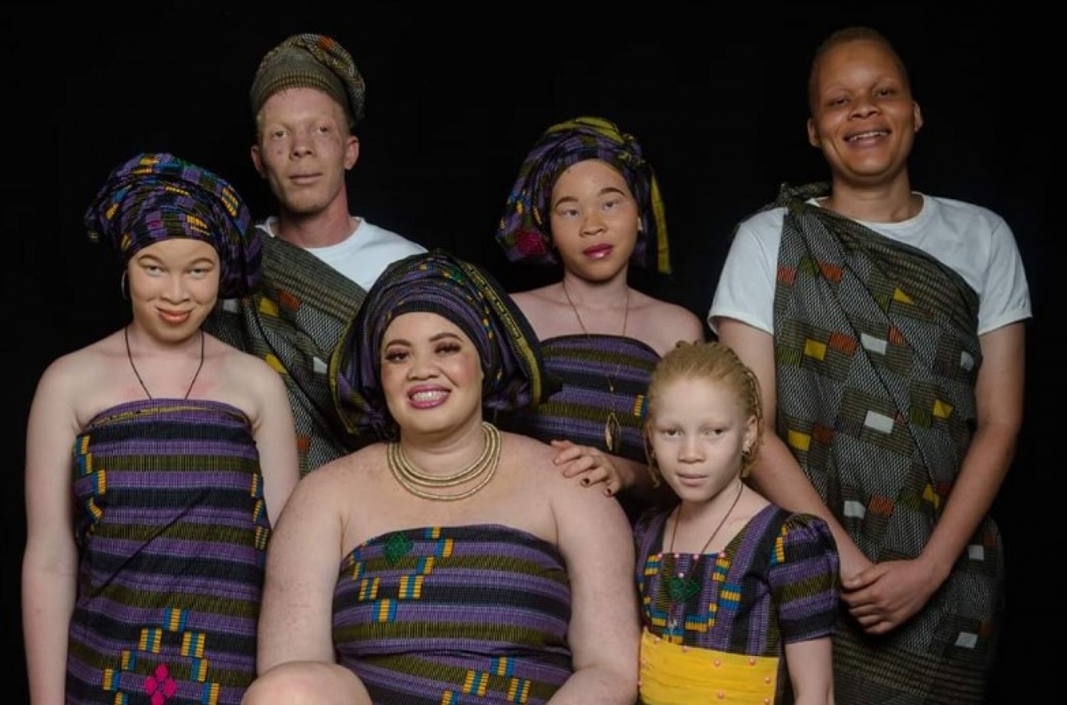 Côte d'Ivoire :    Selon une étude, sur 200 personnes vivant avec l'albinisme, 33,5% sont victimes d'agression verbale