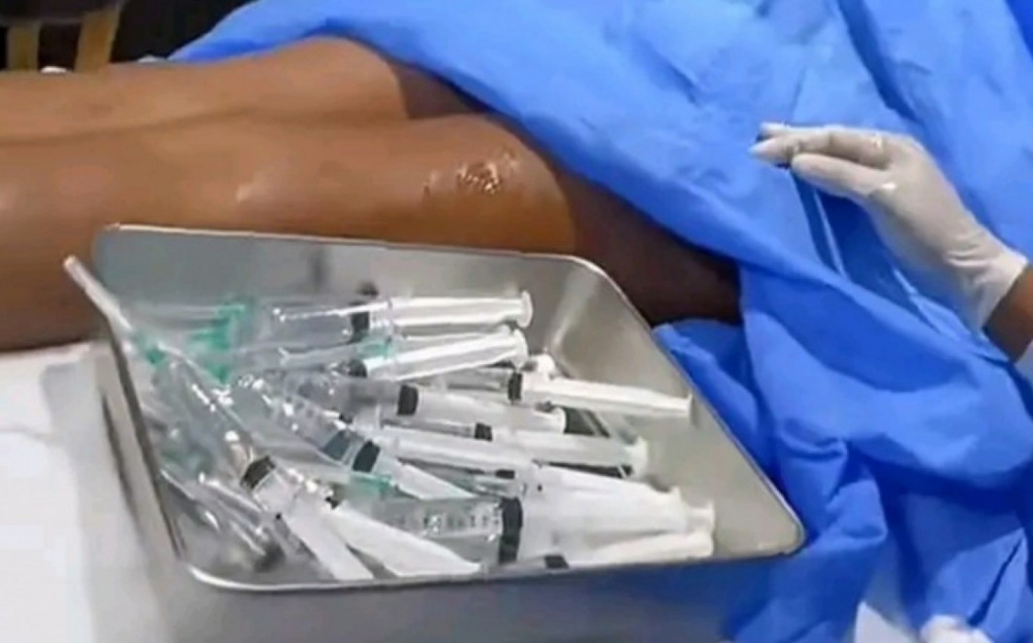 Cameroun : Body filler, quand les influenceuses prennent le bistouri, des spécialistes s'inquiètent pour la santé publique