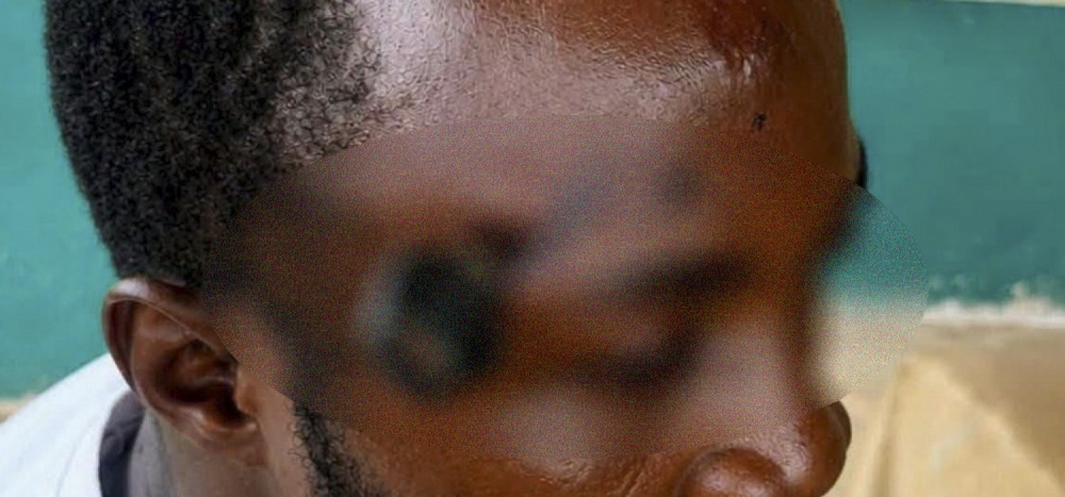 Ghana :  Il tente de s'interpose entre deux bagarreurs et se fait loger une clé dans la tête