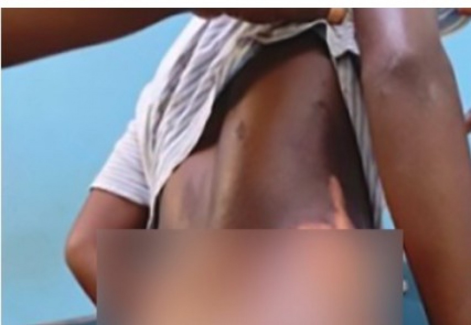 Côte d'Ivoire : Alépé, une soi-disant guérisseuse provoque des brûlures sur le corps d'une sorcière présumée de 14 ans