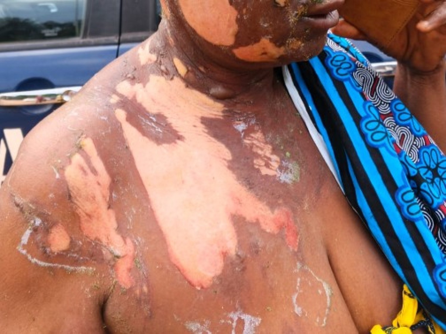 Côte d'Ivoire : Après une altercation violente avec sa rivale, elle souffre de brûlures sévères