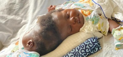 Ghana :  SOS pour des jumeaux siamois à séparer
