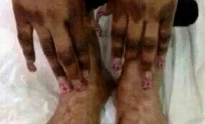 Cameroun : Sous pression, le gouvernement interdit les produits de dépigmentation de la peau