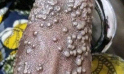 Cameroun : Les autorités sanitaires confirment l'avancée de la variole de singe