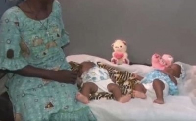 Burkina Faso : Des jumelles siamoises opérées avec succès à Bobo Dioulasso