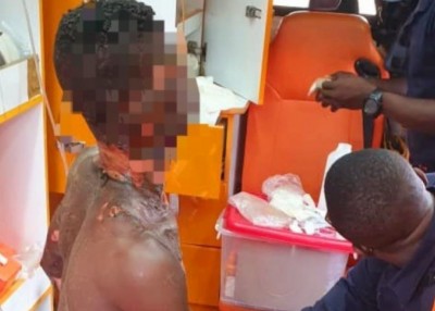 Côte d'Ivoire : Abobo, un présumé voleur battu et brulé partiellement par une foule en colère