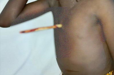 Cameroun : Une fillette de 9 ans sauvée à l'hôpital après avoir reçu une flèche en plein cœur