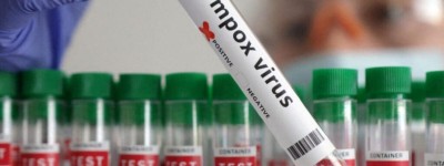 Sénégal : Mpox, un premier cas de variole du singe confirmé à Dakar