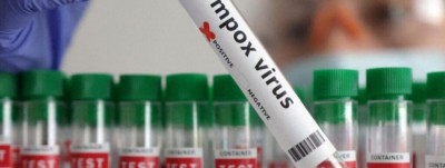 Sénégal : Deux nouveaux cas de Mpox confirmés, portant le total à quatre