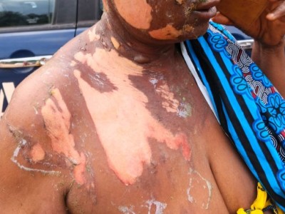 Côte d'Ivoire : Après une altercation violente avec sa rivale, elle souffre de brûlures sévères