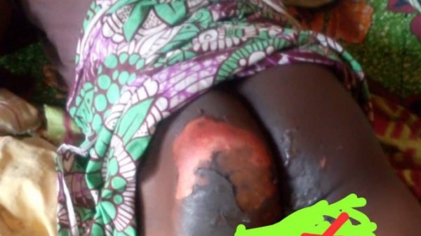 Côte d'Ivoire : Bangolo, accusé de vol de poulet, un jeune contraint de s'asseoir sur des braises ardentes, ses fesses et ses parties intimes brûlées au second degré