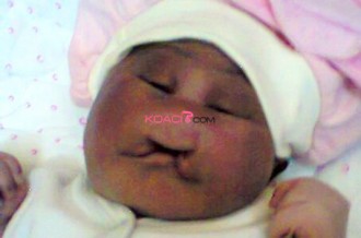 Gabon : Un bébé monstrueux naît à  Bitam