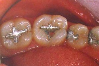 COTE D'IVOIRE: Mercure dentaire, ce petit rien qui tue