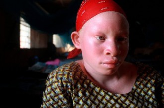 COTE D'IVOIRE : Les Albinos revendiquent leur place dans la société