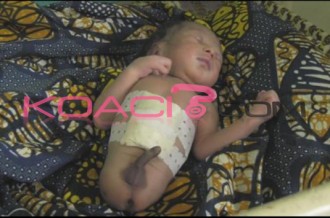 BÉNIN : Un petit garçon naît sans jambes !