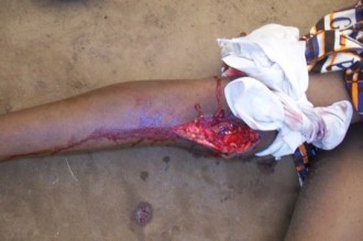 MALI : Un imam fracture les membres de sa femme à  coups de pilon
