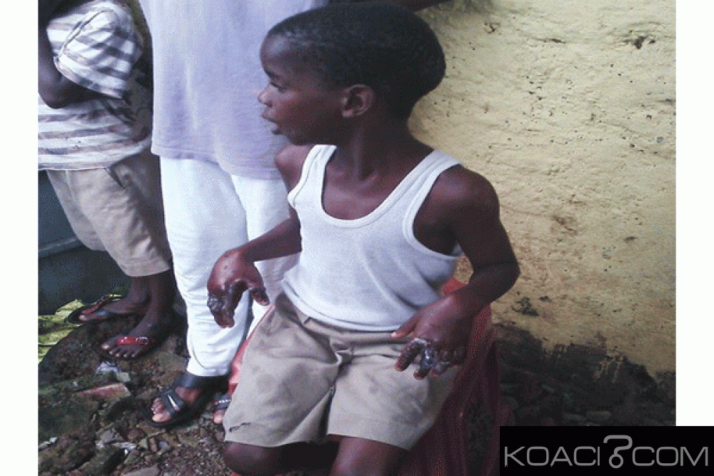 Guinée : Elle repasse le dos de son garçon de 6 ans avec un fer à  repassé et brule ses deux mains pour 500 Francs guinéen