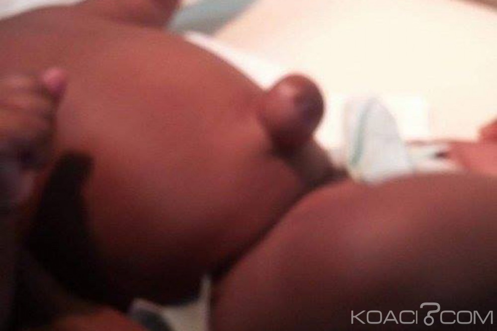 Côte d'Ivoire: Hernie ombilicale du nourrisson, comment résoudre le problème avec une pièce métallique