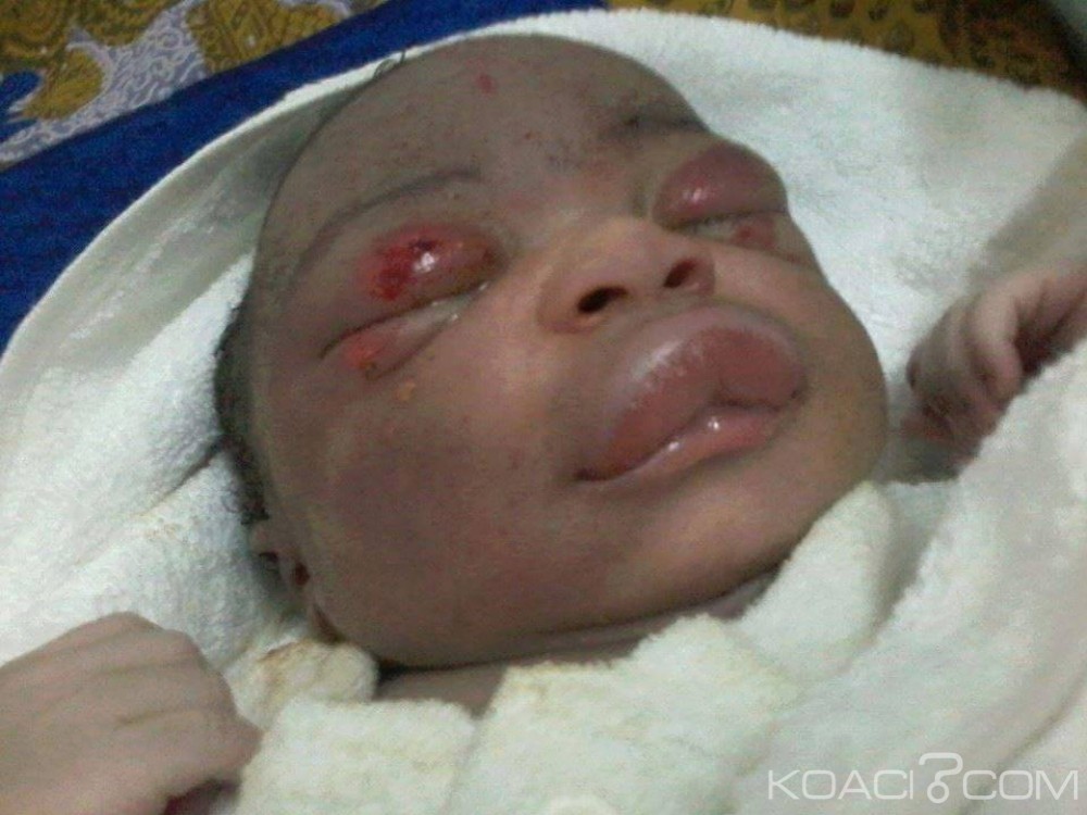 Côte d'Ivoire: Son visage pris pour ses fesses, un bébé boxé par des sages femmes