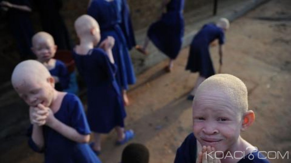 Burundi: Une petite albinos de 5 ans assassinée et démembrée par des bandits