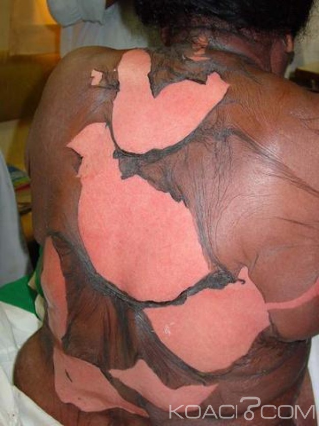 Sénégal: Injection de glutathion ou la nouvelle forme de dépigmentation qui tue
