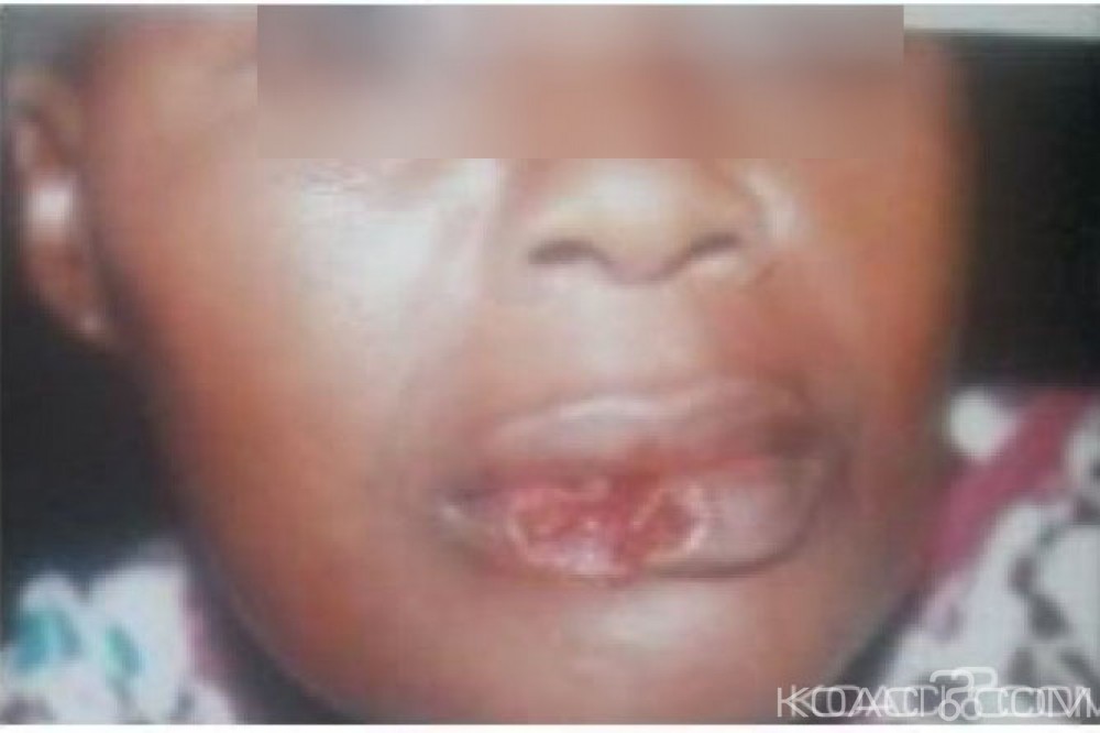 Côte d'Ivoire: Crise de jalousie, elle se rend au domicile de  sa prétendue rivale, cette dernière lui sectionne la lèvre dans la bagarre