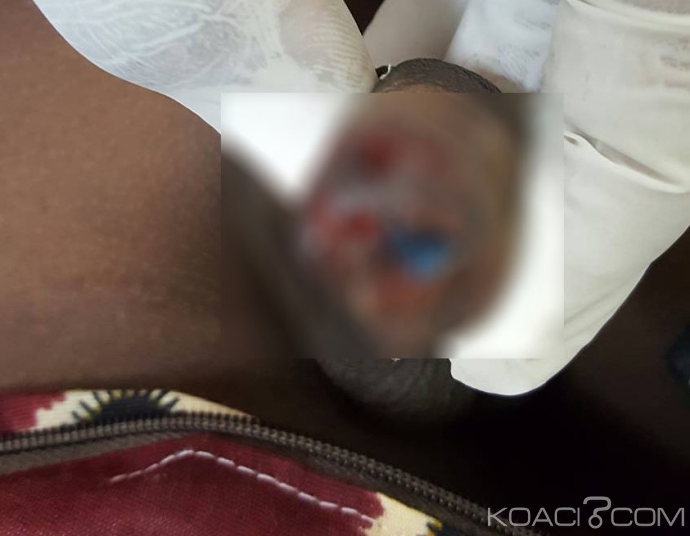 Côte d'Ivoire: Le paiement mobile échoue, la prostituée mord le sexe de son client