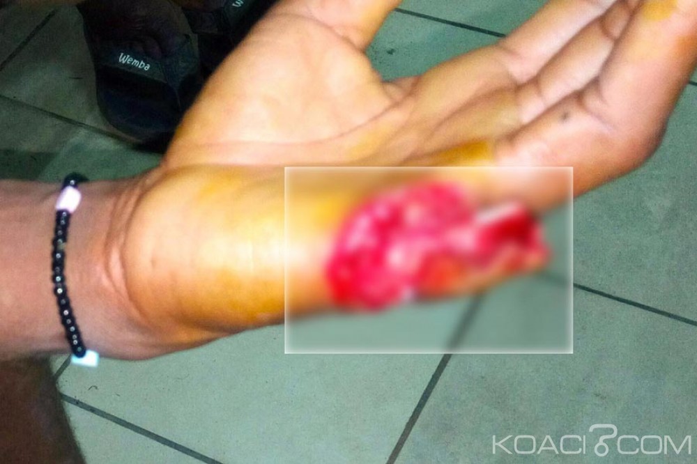 Côte d'Ivoire: Yopougon, les microbes lui coupent un doigt