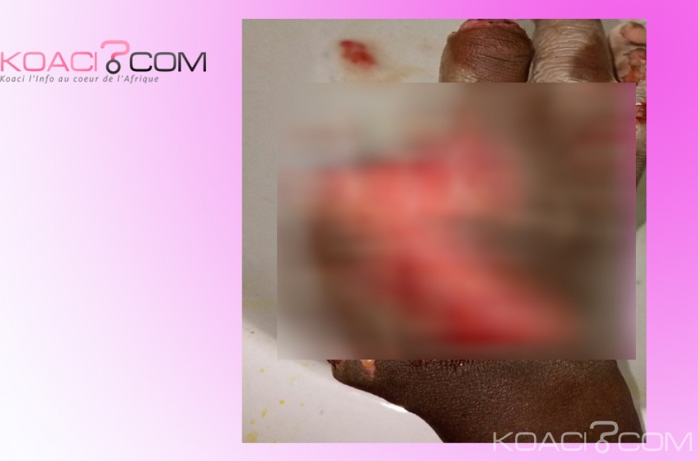 Côte d'Ivoire: Divo, une jeune fille de 15 ans perd 3 doigts dans l'explosion d'un pétard