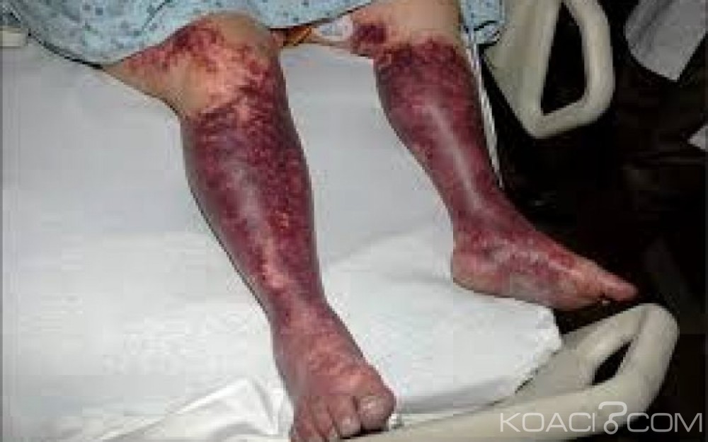 Nigeria: 813 morts en cinq mois suite à  une épidémie de méningite