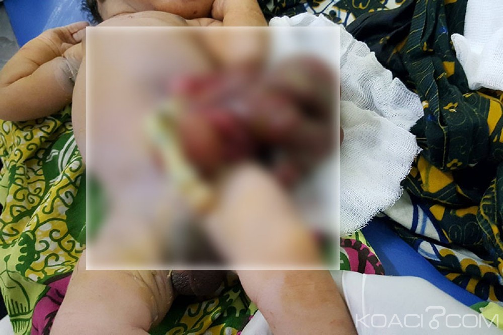 Côte d'Ivoire: Faute d'équipements dans les hôpitaux, voici la malformation qui tue rapidement  les nouveaux nés le laparoschisis