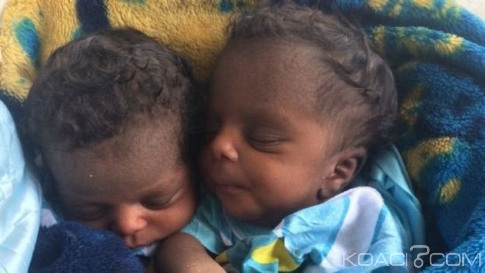 RDC: Deux sœurs siamoises liées par  le  nombril séparées   avec succès