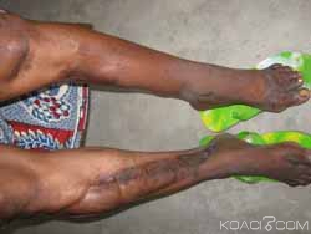 Côte d'Ivoire: Lutte contre le diabète, l'insuline désormais  gratuite pour les malades de 0 à  18 ans