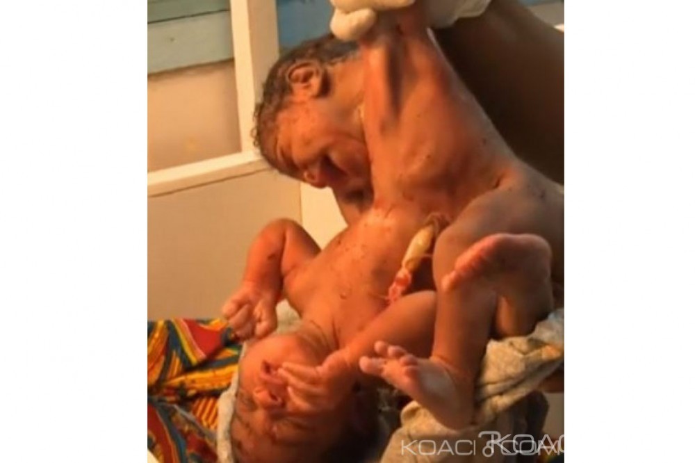 Côte d'Ivoire: Naissance de bébés siamois avec trois jambes  pour la première fois au CHR de Man