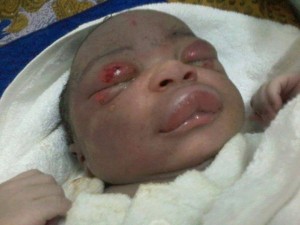 Côte d'Ivoire: Son visage pris pour ses fesses, un bébé boxé par des sages femmes
