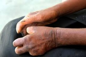 Côte d'Ivoire: Plus d'un milliard de Washington pour lutter contre les maladies tropicales négligées