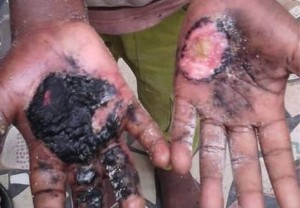 Côte d'Ivoire: Il perd 300frs, sa marà¢tre lui brûle les mains