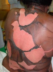 Sénégal: Injection de glutathion ou la nouvelle forme de dépigmentation qui tue