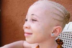 Malawi: Assassinats d'albinos, les sorciers et tradi -patriciens interdits d'exercer
