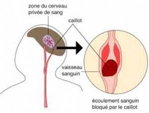 Koacinaute: AVC: les signes qui doivent alerter
