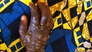 Centrafrique: Une épidémie de «Monkey Pox» fait 10 morts dans l' est