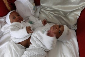 Burkina Faso: Deux bébés siamois de deux semaines séparés avec succès