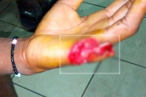 Côte d'Ivoire: Yopougon, les microbes lui coupent un doigt