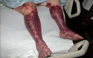 Nigeria: 813 morts en cinq mois suite à  une épidémie de méningite